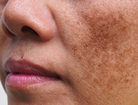 Hóa mỹ phẩm là gì? chúng ảnh hưởng đến làn da như thế nào?