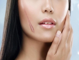Sẹo lồi là gì? Giải pháp xử lý dứt điểm từ N Beauty