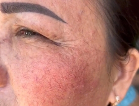 Da nhạy cảm, da yếu là gì? Cách phục hồi hàng rào bảo vệ da đúng cách cho hiệu quả!!