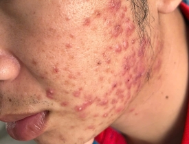 Càng trị mụn da càng nặng, vì sao? Giải pháp an toàn từ N Beauty