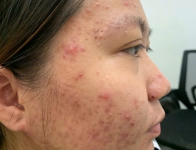 Hành trình chữa lành làn da từ gốc: Vì sao nóng vội chỉ khiến da tổn thương nặng hơn?