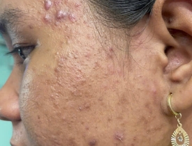 Những dấu hiệu cho thấy da mụn của bạn đang được xử lý sai cách