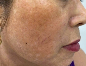 Tác hại của tia UV – Nguyên nhân khiến nám, tàn nhang và sắc tố da càng nặng