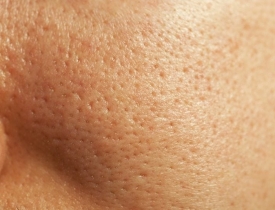 Da sần sùi, lỗ chân lông to – thủ phạm có thể là lớp da chết lâu ngày