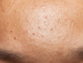 Mụn đầu đen là gì? Nguyên nhân và giải pháp cải thiện da hiệu quả