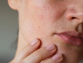 Khám phá bí quyết cải thiện da xỉn màu, sạm nám tại N Beauty Spa