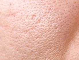 Lỗ chân lông to: Nguyên nhân và vai trò của Toner thảo mộc trong việc cân bằng da, se khít lỗ chân lông